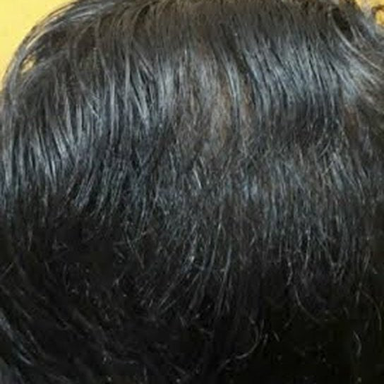 ৬ মাস পর: তালুতে চুল ঘন