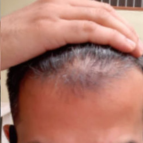 ৪ মাস পর: সামনের দিকে নতুন চুল