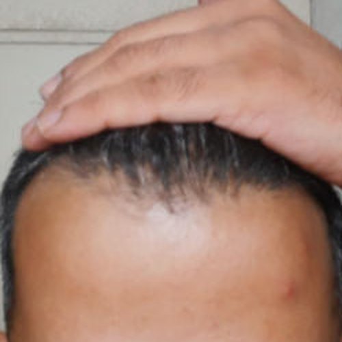 শুরু: সামনের দিকে চুল পাতলা
