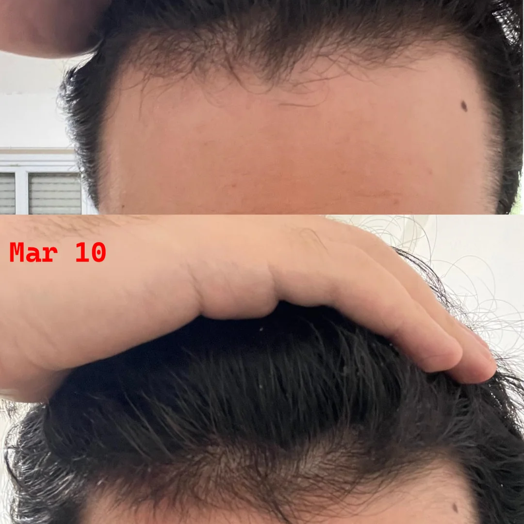 GZen™ Hair Regrowth Kit