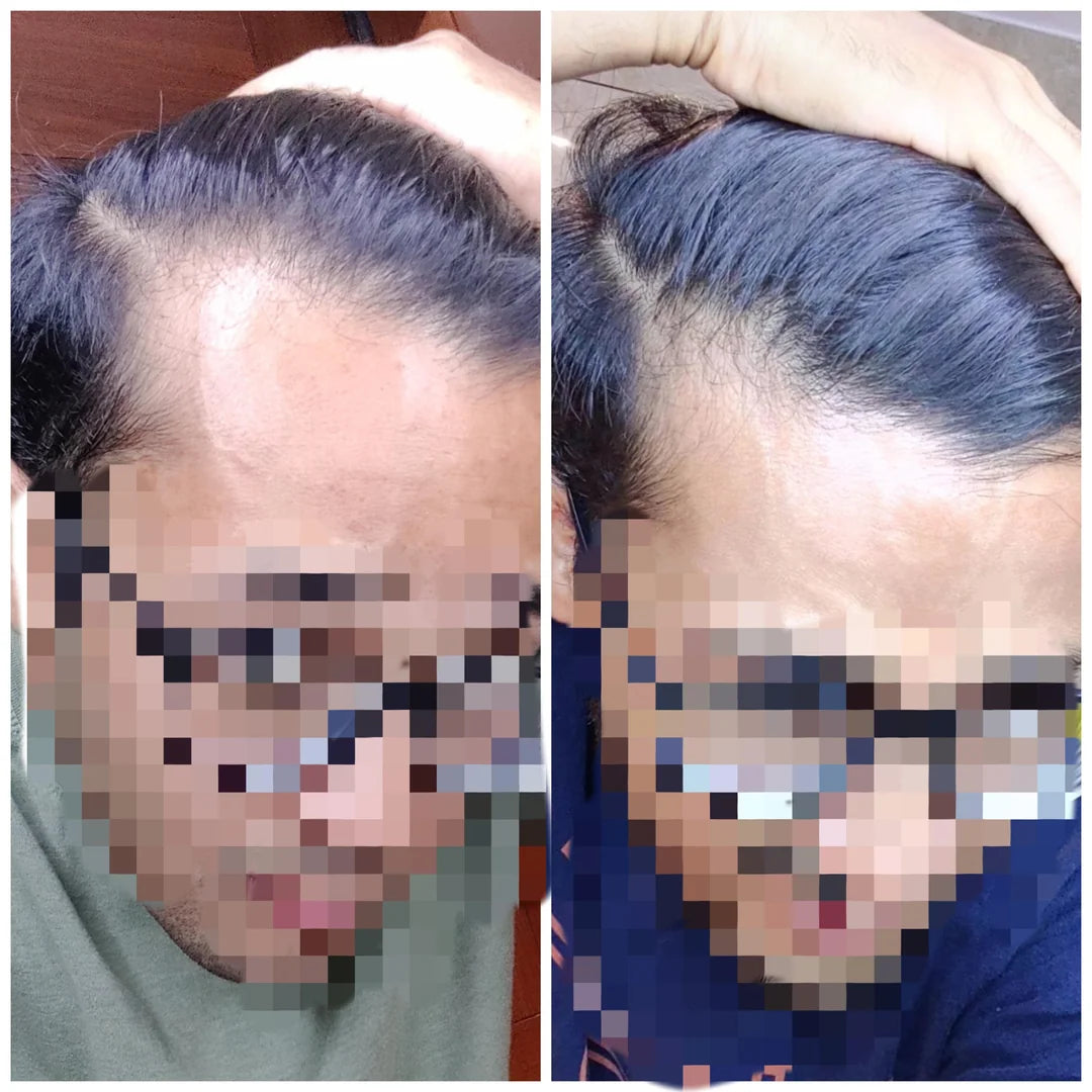 GZen™ Hair Regrowth Kit